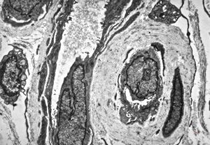 F,48y. | reduplication of endothelial basement membranes - skin - susp. lupus erythematodes